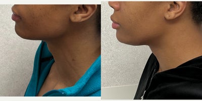 18-24 year old woman treated with Adam's Apple Reduction - this is a young lady who underwent adam's apple reduction.