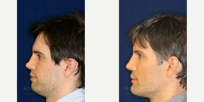 Permanent Non-surgical Rhinoplasty - Patient had prior injury that caused a collapse of the bridge. Permanent Silikon 1000 filler restored the collapsed bridge. Patient also had extended neck sculpture.