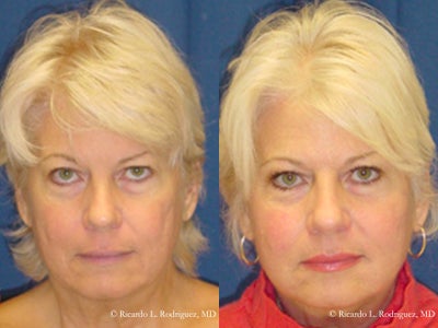 Woman in her 40s treated with Facial Fat Transfer - Woman in her 40s treated with Facial Fat Transfer to lift areas of facial structure and improve appearance of acne scarring
