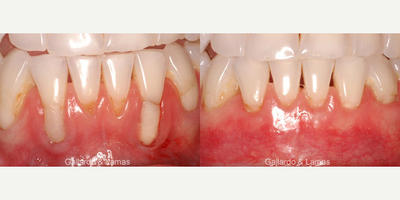 45-54 year old woman treated for Gum Recession - Patient was treated through Alloderm for gum recession.