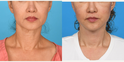 45-54 year old woman treated with Facelift, Neck Lift, Mini Facelift - Mini face and neck lift