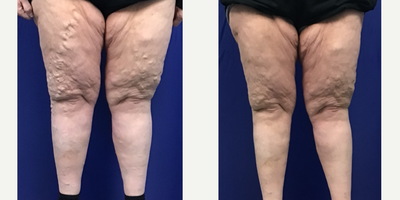 52 year old woman treated with EVLT - 52 year old female vein patient treated with bi-lateral Endovenous Laser Ablation