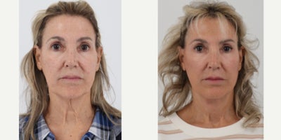 65-74 year old woman treated with Facelift, Neck Lift, TCA Peel - 71 year old 6 months post deep plane facelift, neck lift & TCA Jessner Peel by Dr. Dilip D. Madnani, MD FACS.