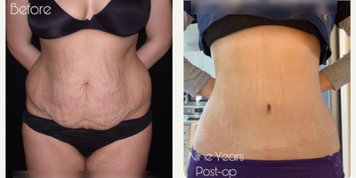 Woman treated with Tummy Tuck - Woman treated with Tummy Tuck