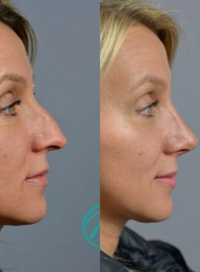 Woman treated with Rhinoplasty - Woman treated with Rhinoplasty