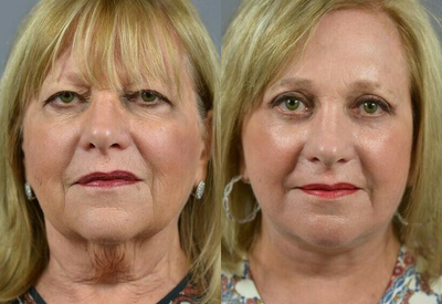 Woman treated with Eyelid Surgery - Woman treated with Eyelid Surgery