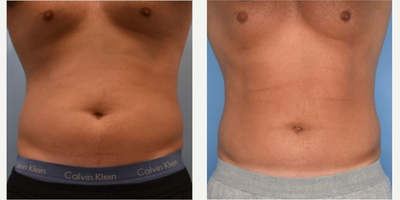 Man treated with CoolSculpting - Man treated with CoolSculpting.