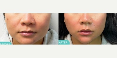 Woman treated with Thread Lift - Woman treated with Thread Lift