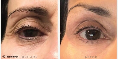 Woman treated with PlasmaPen - What can we treat with Plasma Pen? Excess Eye Bags & Eye Lids  Crows Feet  Lip & Forehead Lines Crepey Neck & Dcollet  Pigmentation