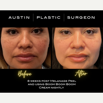 25-34 year old woman treated with Chemical Peel - Melanage Peel By Christine in Austin TX