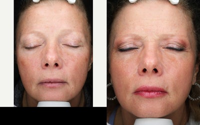 55-64 year old woman treated with Halo Laser, BroadBand Light (BBL) - Patient received 1 HALO and 1 BBL treatment.