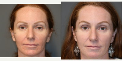 Acne Scars and Fat Transfer - Acne scars treated with laser resurfacing and stem cell rich fat transfer.