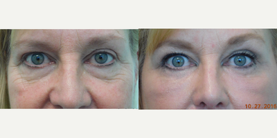 55-64 year old woman treated with Fractional Laser and Fat Transfer - This client presented with desire to rejuvenate her lower eyelids. She was unhappy about the appearance of the lower eyelid wrinkles and perceived hollowness in the upper cheek region. Under local anesthesia and oral sedation with valium, we performed a fractional CO2 laser treatment to her lower eyelids and crow's feet along with fat transfer to her lower eye rims and upper cheeks. Her results demonstrate marked improvement in the wrinkles and hollowness with creation of a smooth transition from her cheeks to her lower eyelids.
