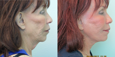 65-74 year old woman treated with Facelift Revision - This patient presented with the complaint of insufficient overall result from her first facelift (performed by another surgeon) approximately one year prior. She had hoped for more improvement in the definition of her jawline, as well as greater tightening of her neck skin and platysma muscle. She complained of odd creasing/webbing at the top part of her ear, as well as a pulling sensation in front of her ear (specifically the cartilage in front of the ear canal). After evaluation, we decided to perform a revision lower facelift and necklift under local anesthesia in our Center. Her results demonstrate overall improved jawline and neck contour, with improvement in the incisions (and pulling effect) around her ears. The procedure time was slightly under two hours, and her recovery was approximately one week.
