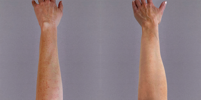 Lumecca IPL - Lumecca is a versatile intense pulsed light (IPL) therapy that effectively treats sun damage and age spots on the whole body, including the arms. Its powerful light energy targets and diminishes skin discolorations, enhancing skin clarity and rejuvenating the appearance of skin. Lumecca is a superior IPL treatment compared to others based on its high peak power delivery results, in fewer treatment sessions.