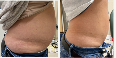 35-44 year old woman treated with truSculpt - 35-44 year old woman treated with truSculpt