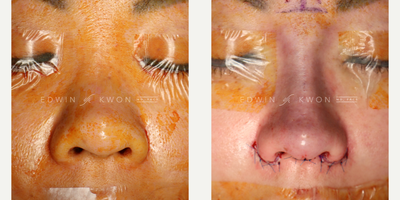35-44 year old woman treated with Asian Rhinoplasty, Rhinoplasty - 35-44 year old woman treated with DCF rhinoplasty.  Patient has been getting fillers to her nose but has started to widen as time has gone on. The filler was dissolved pre-operatively and intra-operatively. The nasal bridge was re-augmented with a DCF graft with a narrower dorsum. The tip projection was increased and nasal tip refined.  Patient also had an alar base reduction to reduce the overall width of the nose and decrease flaring.