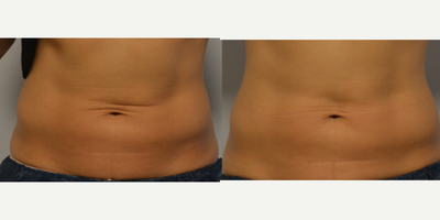 35-44 year old woman treated with Venus Legacy - Patient treated abdominal area, 8 treatment, weekly. Patient showed results by the end of her series