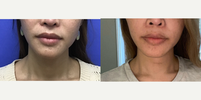 Patient treated with Adam's Apple Reduction - Thyroid Cartilage Shave - 35 to 44 year-old female patient is 3.5 months post-op from Facial Feminization surgery. Her procedures included: Thyroid Cartilage Shave and Voice Feminization.