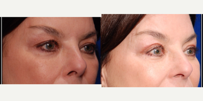 55-64 year old woman treated with Eyelid Surgery - Upper Blepharoplasty New Orleans by Dr. Sean Weiss - Facial Plastic Surgery