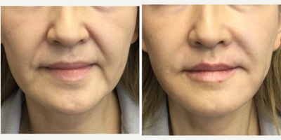 55-64 year old woman treated with Contour Thread Lift - 55 year old Asian female - received Sculptra Aesthetic to soften the oral commissures and nasolabial lines while adding 2 Infiniti Threads to pull the jowls up and build collagen.  She also received a half syringe of Restylane Kysse in the lips for anti-aging rather than volume.
