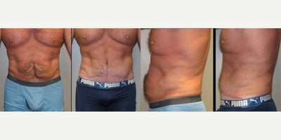 55-64 year old man treated with Belly Button Surgery, Laser Liposuction, Liposculpture, Liposuction, Male Tummy Tuck, Mini Tummy - This is a 58-year-old gentleman who has a history of a ruptured appendicitis which resulted in a colostomy bag and scarring in the lower tummy. He also had a hernia which is repaired. He presented with concerns regarding the skin folding and scarring in the tummy. He successfully had liposuction of the abdomen with skin removal and umbilicoplasty 4 months ago meeting his expectations.