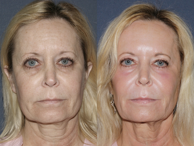 Fraxel Repair Female Patient - Fraxel Repair for complete facial rejuvenation.