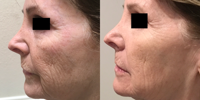55-64 year old woman treated with Laser Resurfacing - Female treated with ICON Three for me IPL, XD & XF laser. She received 3 treatments spaced about 6 weeks apart.