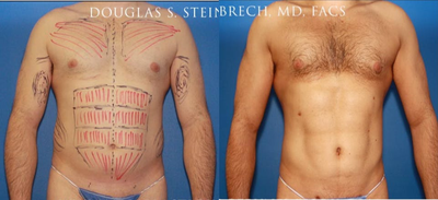 Man treated with Bicep Implants - Man treated with Bicep Implants