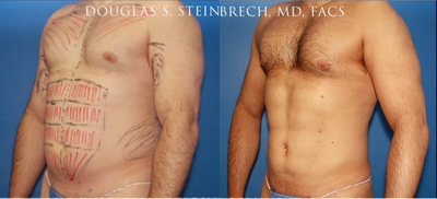 Man treated with Bicep Implants - Man treated with Bicep Implants