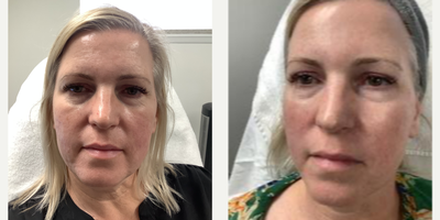 45-54 year old woman treated with Lumecca, Morpheus8 (Face, Neck, Eyes) with PRP - 50 yo Pt who started her Facial rejuvenation treatments in May 2022 and completed her last treatments in September 2022. Pt wanted a refreshed look: tightening, brightening, reduction of age/sun spots, and improvement in her overall complexion. She was noted to have a few acne scars and superficial wrinkles on her forehead and around her mouth. She also wanted to reduce the dark circles under her eyes. At the time of her treatments, Pt wanted to avoid any surgical interventions and injectables. She had also invested in switching her skin care routine with medical grade skin care products (Skinceuticals). She admitted to inconsistent use of sunscreen over the years and often had sunburned skin. Pt received 4 Lumecca treatments, 3 Morpheus 8 treatments targeting under the eyes (Prime tip), face and neck. She also had PRP applied after each Morpheus 8 session. Pt was very pleased with her overall results. As the photos show, she had improvements in all the areas of concern she had initially. She was even noted to have more defined areas around the cheeks, chin, and jawline, as well as a reduction of the nasolabial folds and wrinkles across her forehead.Pt stated that she would return for maintenance treatments as desired.