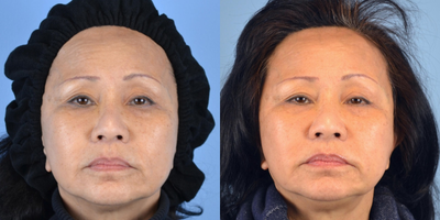 65-74 year old woman treated with ArteFill - 66 year old female received ArteFill to cheeks, chin and under eyes