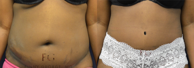 25-34 year old woman treated with Tummy Tuck - This patient underwent an abdominoplasty without complication.