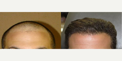 Patient treated with NeoGraft - Patient treated with NeoGraft