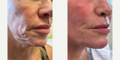 Woman treated with Ultherapy, Thermage, Microneedling RF, Dermal Fillers - You dont always have to have cutting surgery to improve your skin especially the skin around the mouth & jowl areas. A combination of laser resurfacing, Ultherapy, Thermage, microneedling & judicious injection of fillers can be used to tighten the skin. Downtime is minimal & results last for several years.