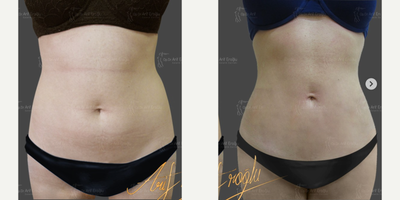 Woman treated with Laser Liposuction, Lipo 360 - 360 Abdomen & Waist 3D Laser Lipolysis Postop 6 moths laterThis procedure to slim the waistline and get rid of the stubborn belly fatAlso tightened the loose skin using 1319 nm tightening laser