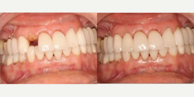 Patient treated with Smile Makeover - Empower Your Smile is here with prompt solutions, offering crowns to restore your smile!