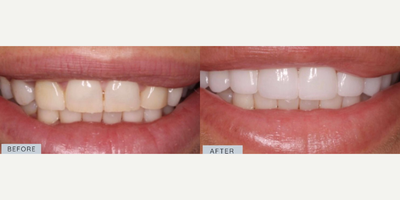 Woman treated with Teeth Whitening - Smile Makeover