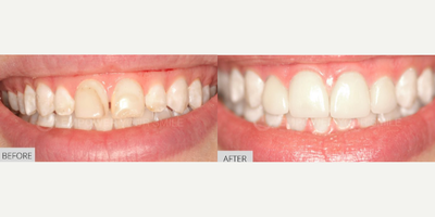 Patient treated with Teeth Whitening - Before and after Dental Laminates
