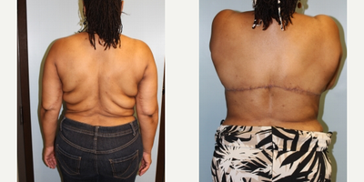35-44 year old woman treated with Skin Tightening - Posterior bra line lift.