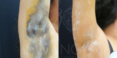 31-year old woman treated with miraDry - This patient suffered from excessive sweating and 3 months after treatment, patient saw 90% improvement. Our Miradry patients have reported an average of 70% improvement at one year and 60% to 70% improvement at 2 years with a single treatment. The results are even better with 2nd treatment. We believe that MiraDry has long lasting effect on sweat and odor reduction. We use the starch-iodine test as a guide to help us capture the most active areas of sweating. The iodine stain seen in the pre treatment photo shows the sweat glands most active in the underarms. After 1st treatment, the iodine stain shows significant decrease of active sweat glands. MiraDry is a non-invasive, non-surgical alternative which has proven to be quite effective in sweat/odor reduction. MiraDry has very minimal risk and complication profile and has shown to be quite effective in our practice for the past 2 year.