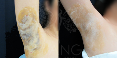 30-year old woman treated with miraDry - This patient suffered from excessive sweating and 3 months after treatment, patient saw 80% improvement. Our Miradry patients have reported an average of 70% improvement at one year and 60% to 70% improvement at 2 years with a single treatment. The results are even better with 2nd treatment. We believe that MiraDry has long lasting effect on sweat and odor reduction. We use the starch-iodine test as a guide to help us capture the most active areas of sweating. The iodine stains seen in the pre treatment photo shows the sweat glands most active in the underarms. After 1st treatment, the iodine stain shows significant decrease of active sweat glands. MiraDry is a non-invasive, non-surgical alternative which has proven to be quite effective in sweat/odor reduction. MiraDry has very minimal risk and complication profile and has shown to be quite effective in our practice for the past 2 year.