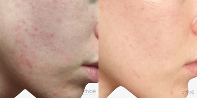 Dilated Pores Treatment using Chemical Peel - Skin pores allow the skin to breathe and to evacuate impurities. They can sometimes become clogged and dilated, giving the skin an irregular appearance. This condition can be effectively treated with chemical peels.
