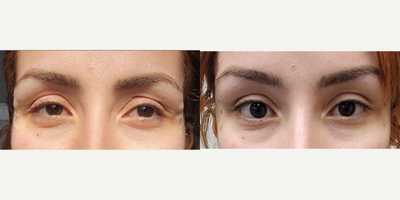 25-34 year old woman treated with Upneeq - Upneeq Treatment done on eyes