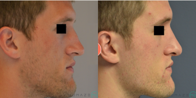 Man treated with Rhinoplasty - Man treated with Rhinoplasty