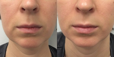 35-44 year old woman treated with Contour Thread Lift - One week after Silhouette Instalift with only one suture per cheek