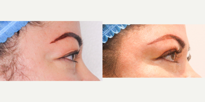 45-54 year old woman treated with Eyelid Surgery - The rejuvenation of the eyes is a delicate and precise procedure. This procedure involves the intervention of both the upper and lower eyelids, with surgical incisions made to reduce excess skin and volume. For the upper eyelid, a small incision is made in the middle of the mobile area - usually within the crease when opened - to remove any excess skin. In regards to the lower eyelid, a transpalpebral incision is made on the edge of the eyelashes. Through this procedure, patient can expect natural-looking results that enhance their eye area overall. When performed by an experienced professional, this procedure can help restore youthfulness in those wanting to appear more vibrant and rejuvenated.