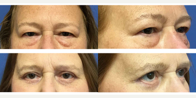 55-64 year old woman treated with Eyelid Surgery - She no longer looks tired after her upper and lower lid blepharoplasty.