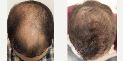 25-34 year old man treated with PRP for Hair Loss - Patient treated with PRP for Hair loss