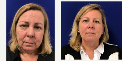 45-54 year old woman treated with Restylane - My 55 year old patient was not happy with her tired appearance. She did not want to do anything surgical but wanted to look refreshed. I used Voluma to add volume in her cheeks, I placed Restylane defyne into the nasolabial and marionette lines, I placed Belotero filler to the under eye area and I placed Botox in her upper face. Here she is 2 weeks post injections looking refreshed and rejuvenated.